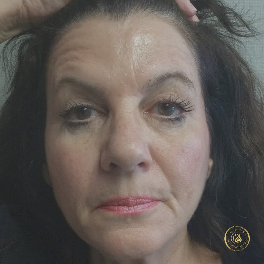 botox after photo by michigan cosmetic surgery in southfield mi
