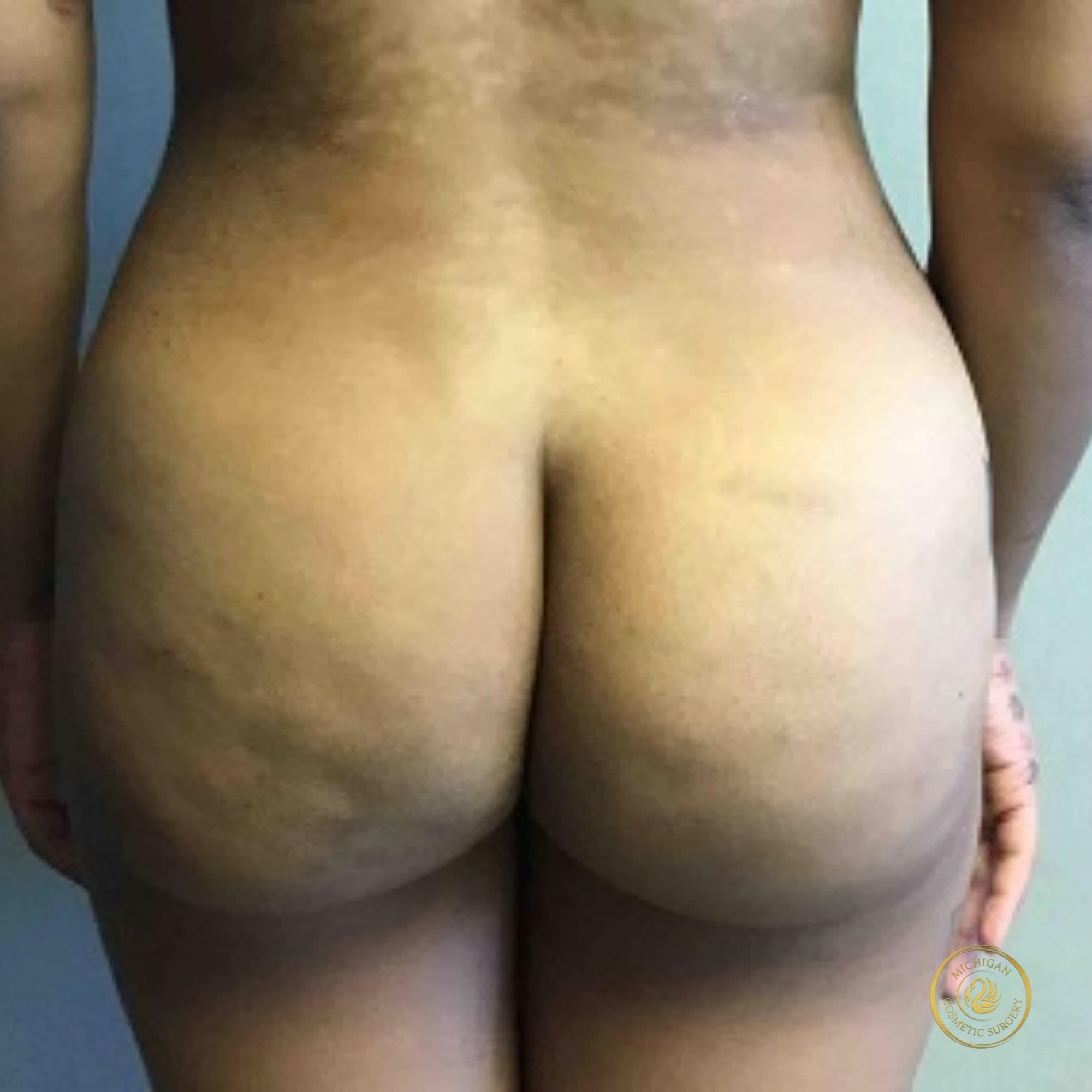 brazilian butt lift after photo by michigan cosmetic surgery in southfield mi