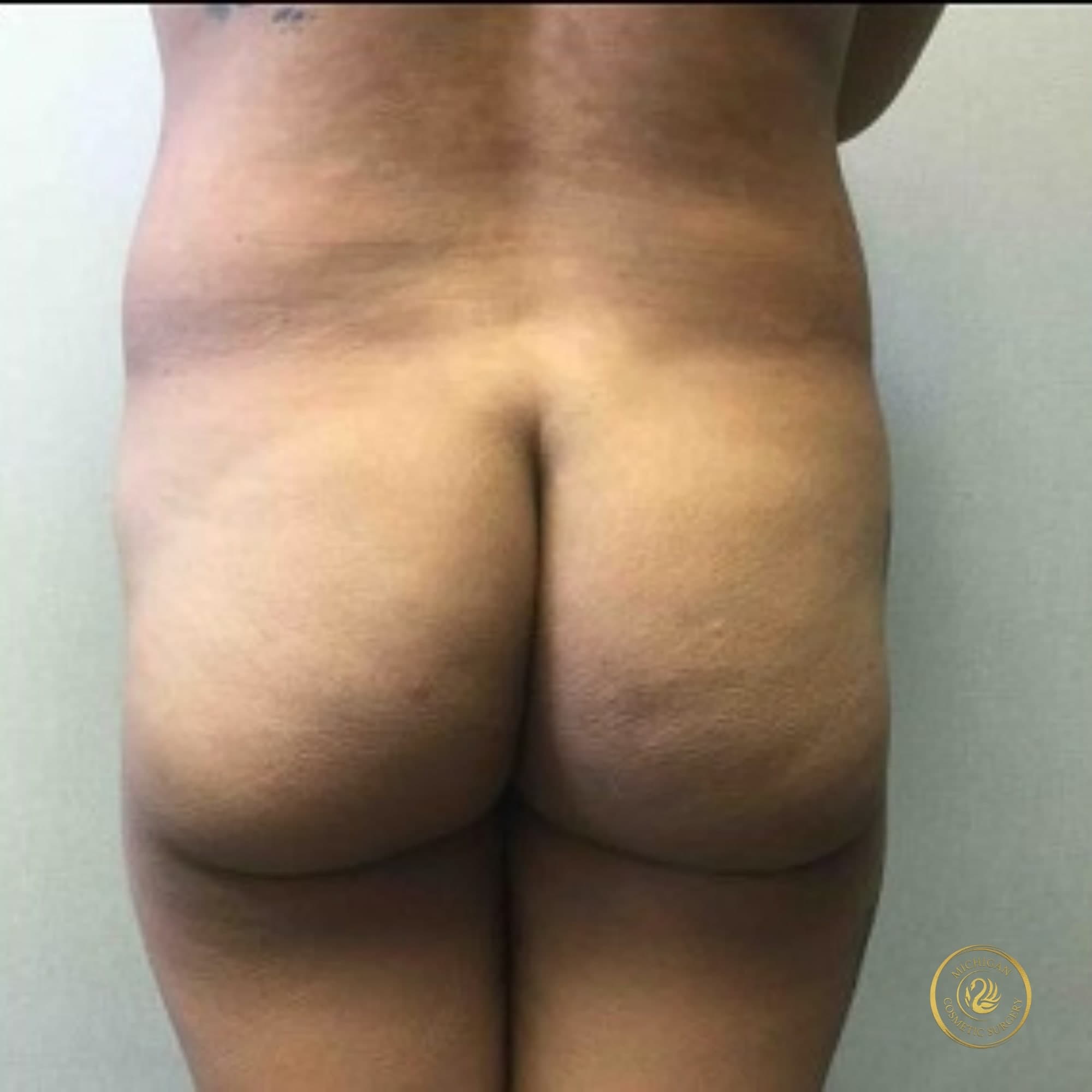 brazilian butt lift before photo by michigan cosmetic surgery in southfield mi