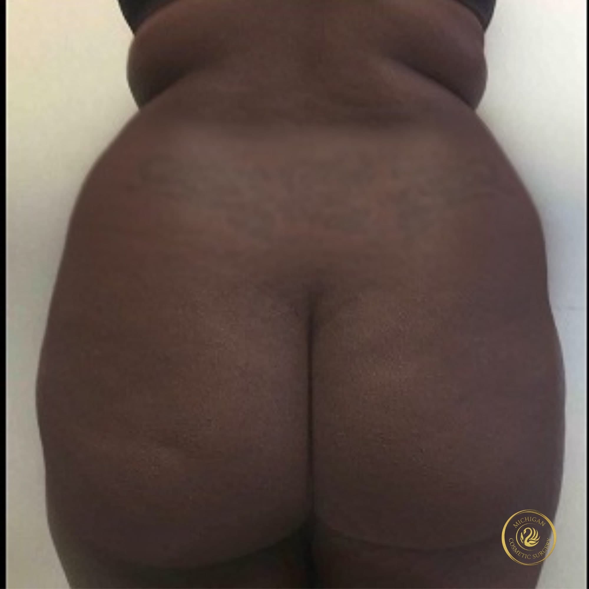 brazilian butt lift before photo by michigan cosmetic surgery in southfield mi