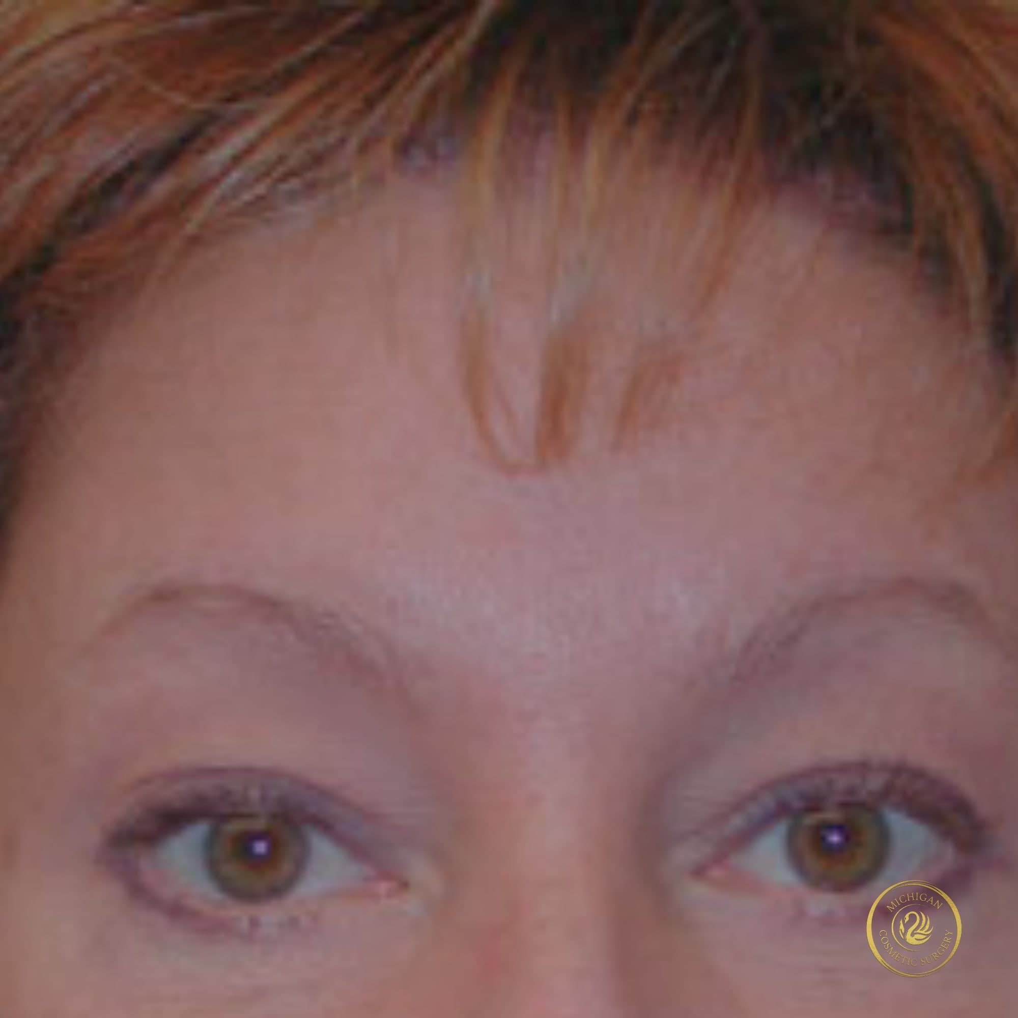 brow lift after photo by michigan cosmetic surgery in southfield mi