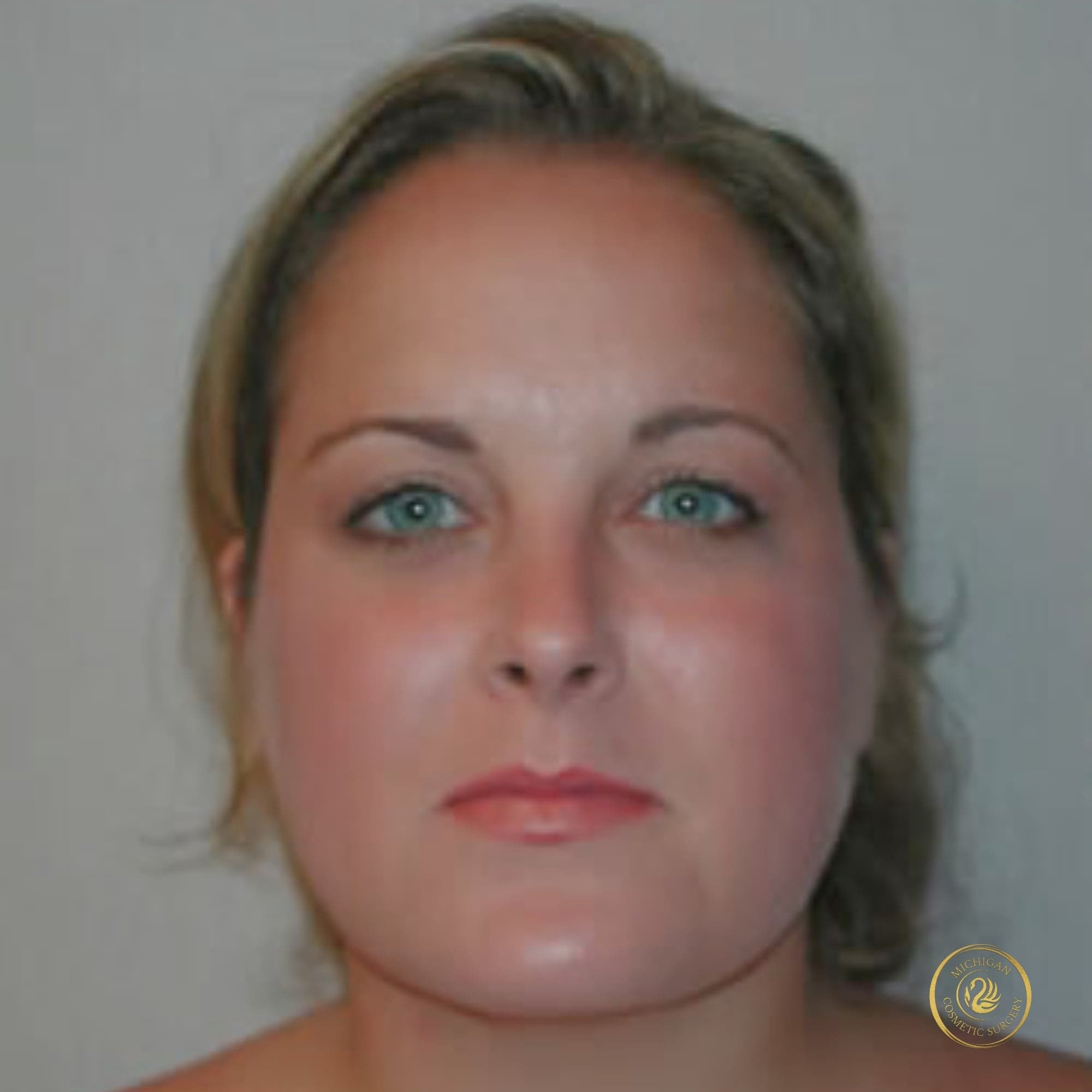 chin liposuction after photo by michigan cosmetic surgery in southfield mi