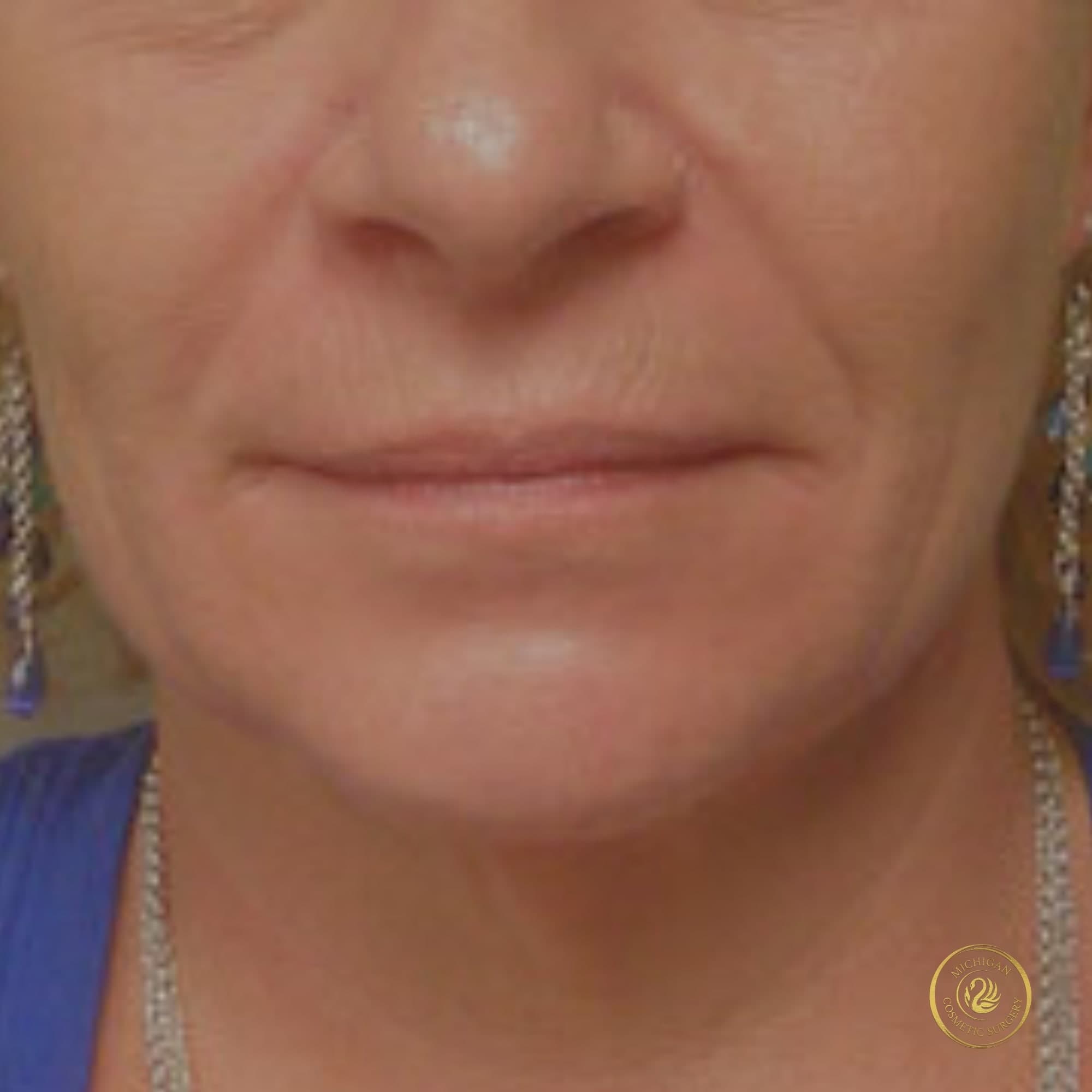 facelift after photo by michigan cosmetic surgery in southfield mi