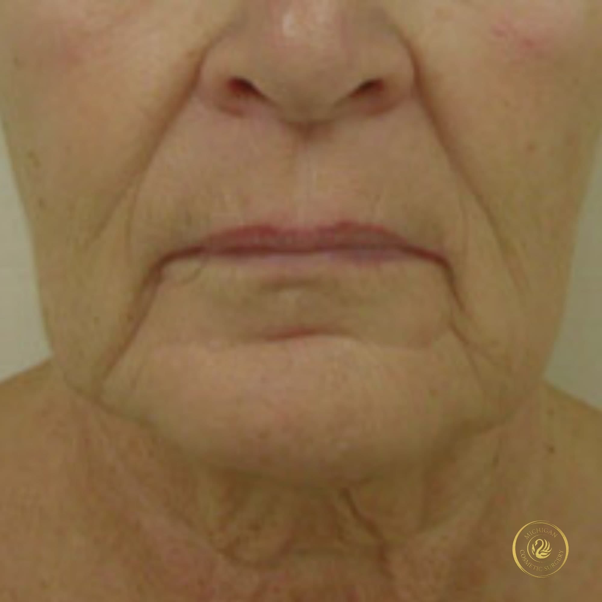 facelift before photo by michigan cosmetic surgery in southfield mi