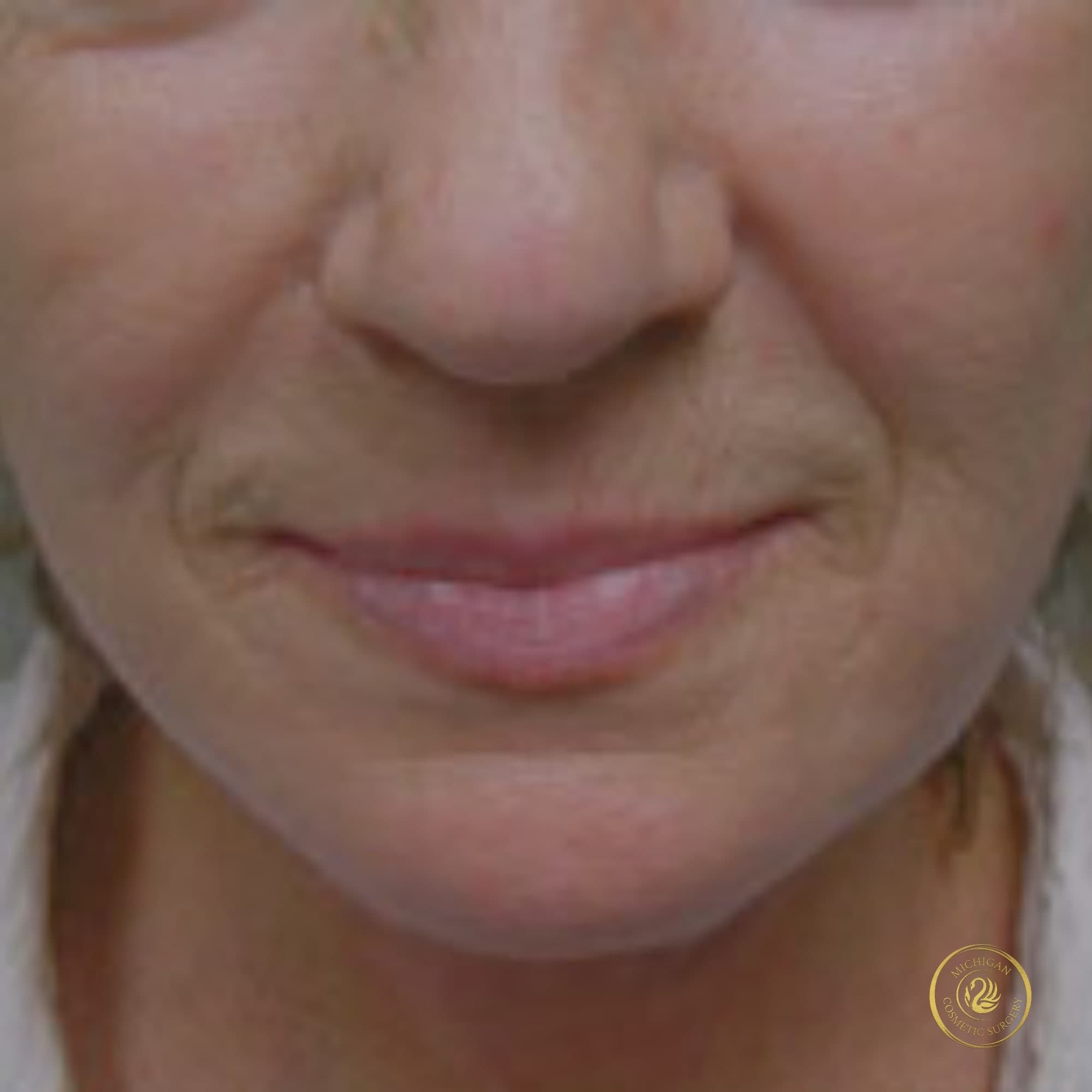 facelift after photo by michigan cosmetic surgery in southfield mi