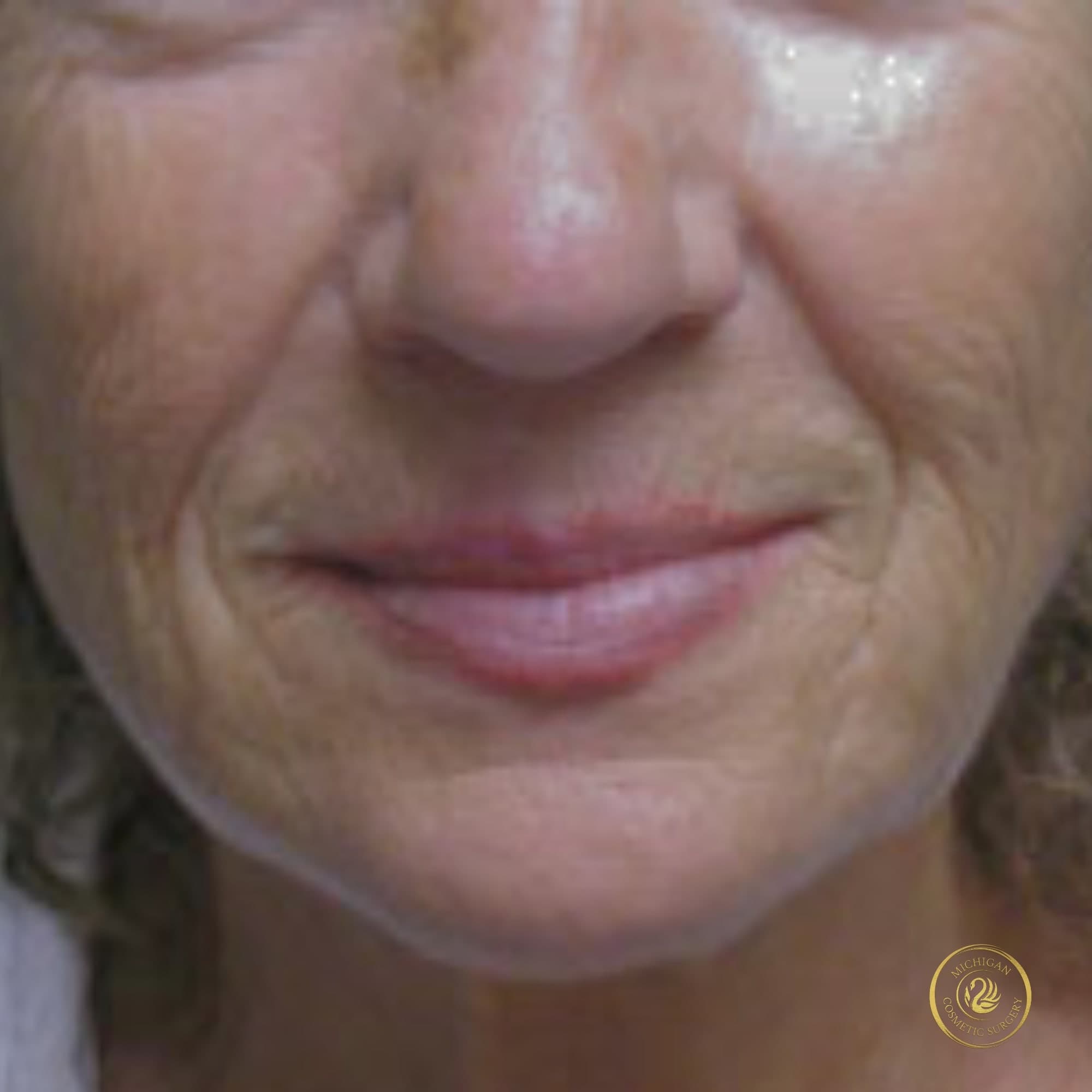 facelift before photo by michigan cosmetic surgery in southfield mi
