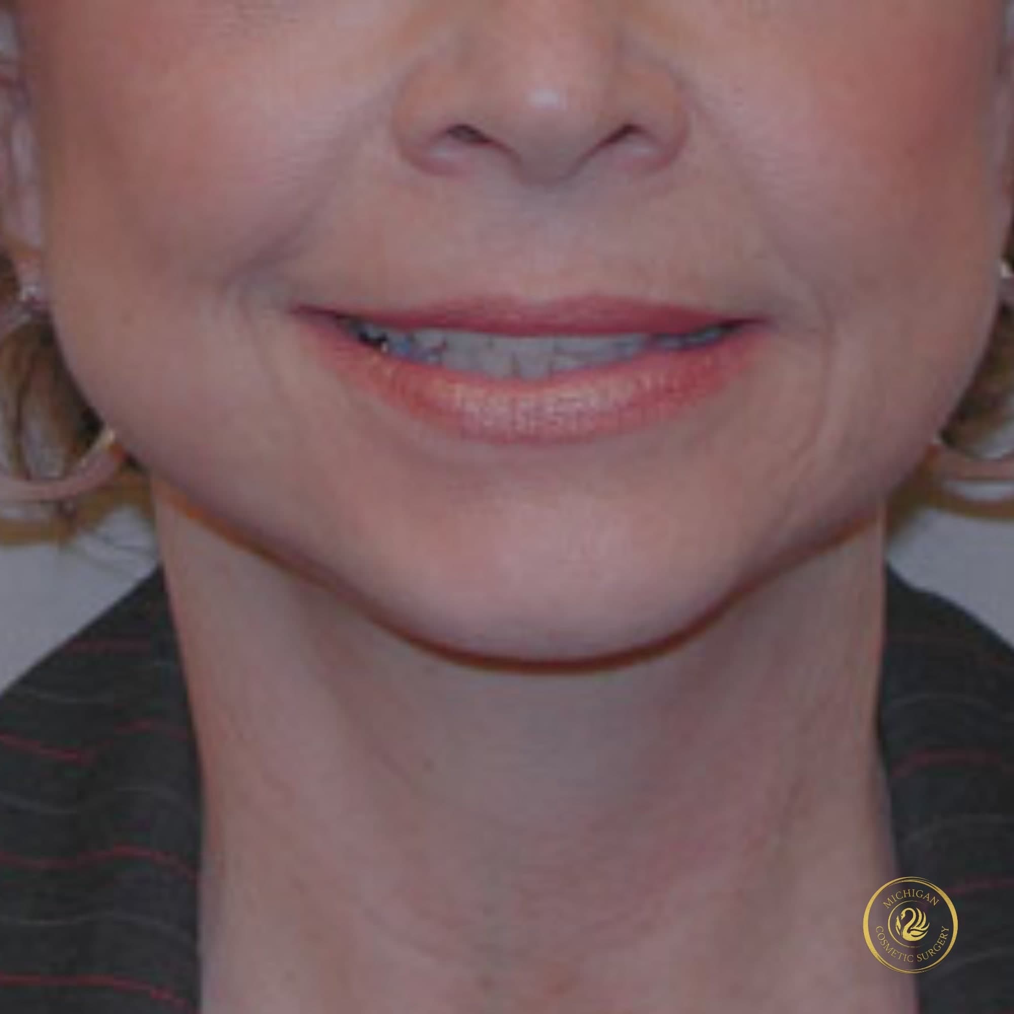 facelift after photo by michigan cosmetic surgery in southfield mi