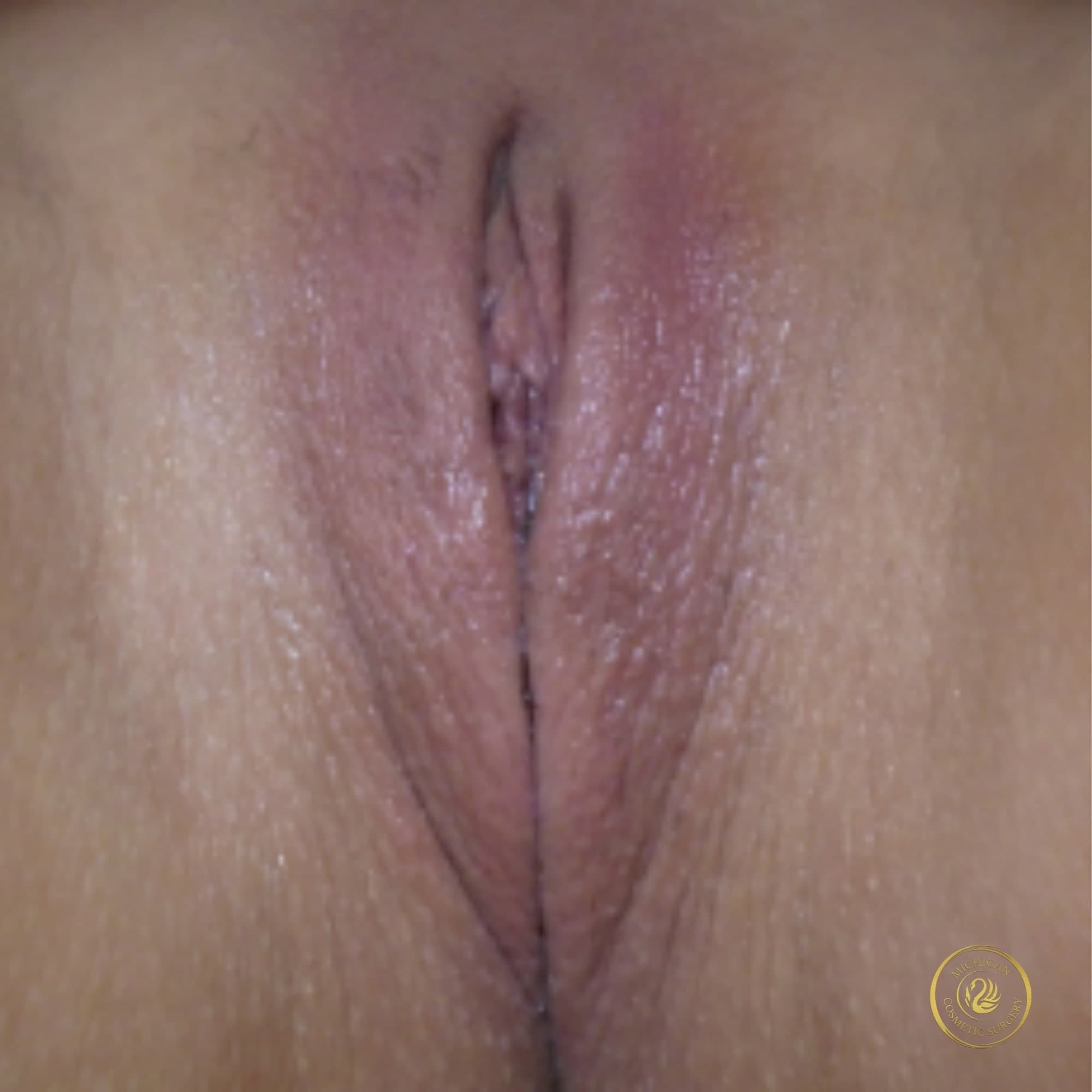 labiaplasty after photo by michigan cosmetic surgery in southfield mi