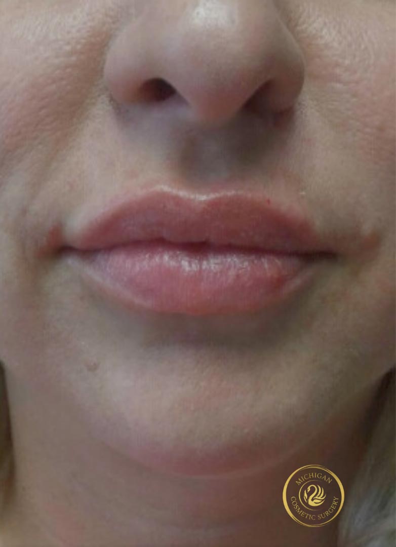 filler after photo by michigan cosmetic surgery in southfield mi