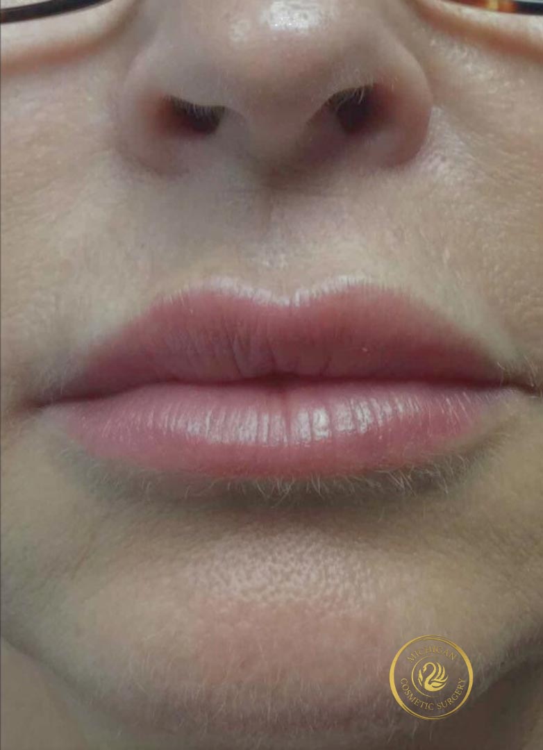 filler after photo by michigan cosmetic surgery in southfield mi