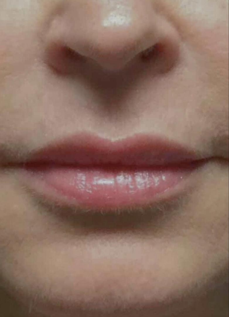 filler before photo by michigan cosmetic surgery in southfield mi