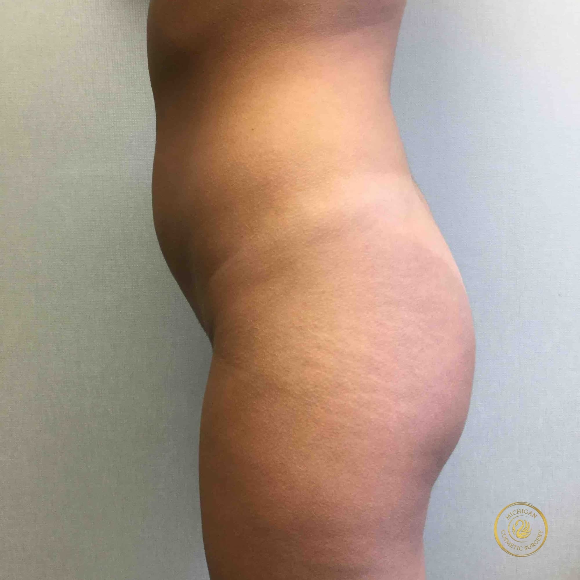 liposuction before photo by michigan cosmetic surgery in southfield mi