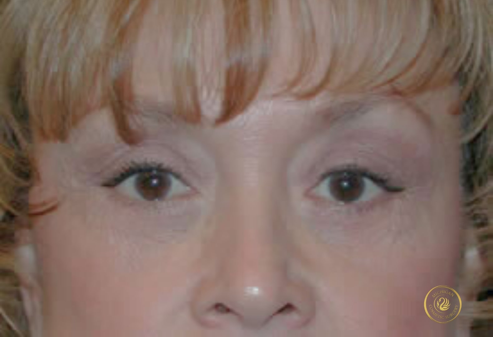 blepharoplasty after photo by michigan cosmetic surgery in southfield mi