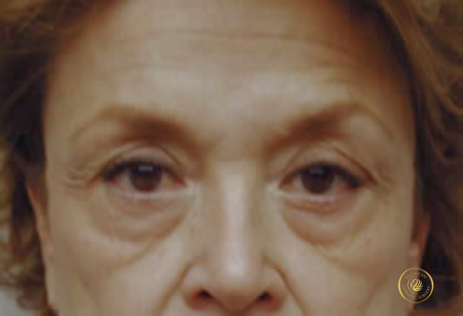 blepharoplasty before photo by michigan cosmetic surgery in southfield mi