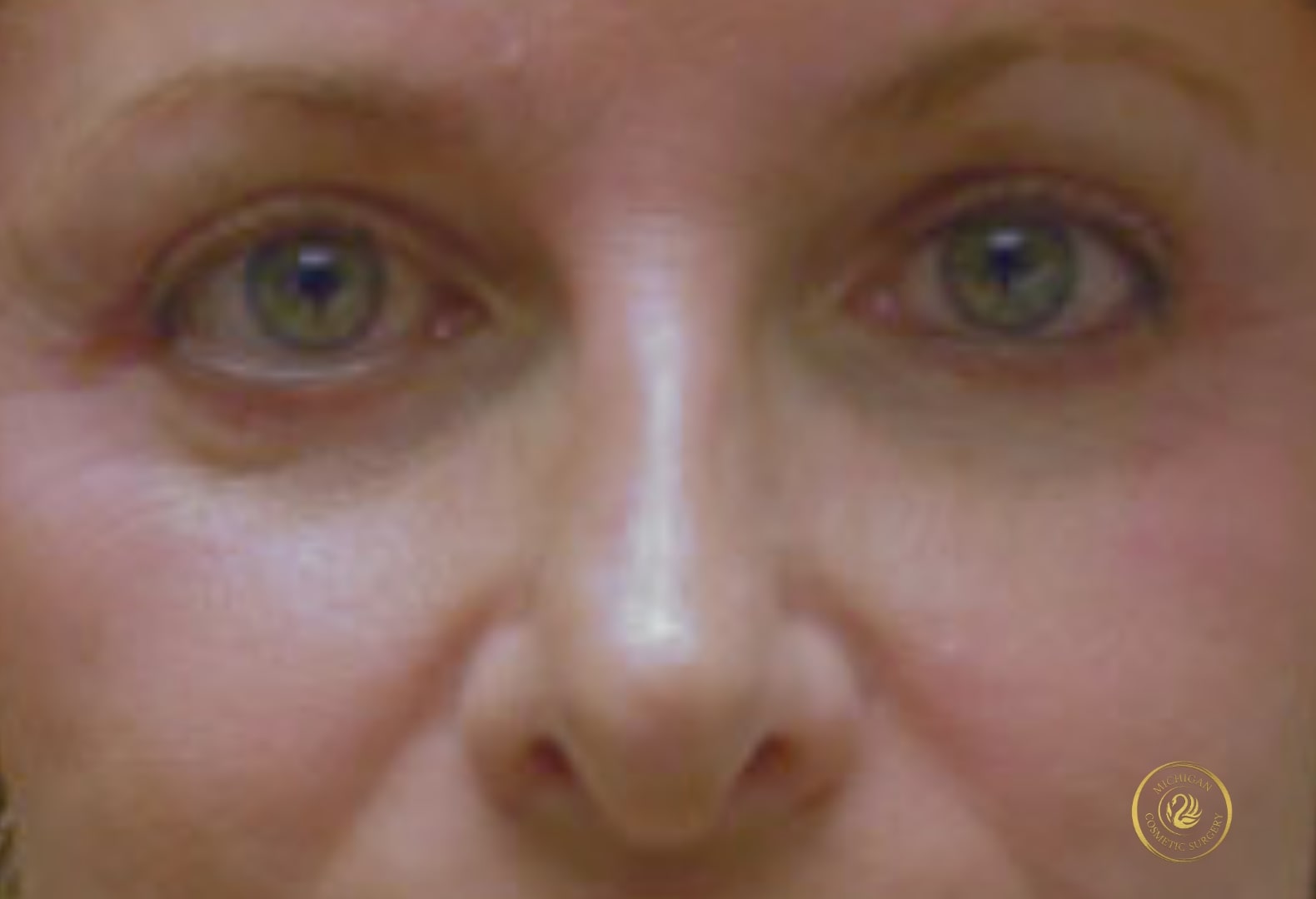 blepharoplasty after photo by michigan cosmetic surgery in southfield mi