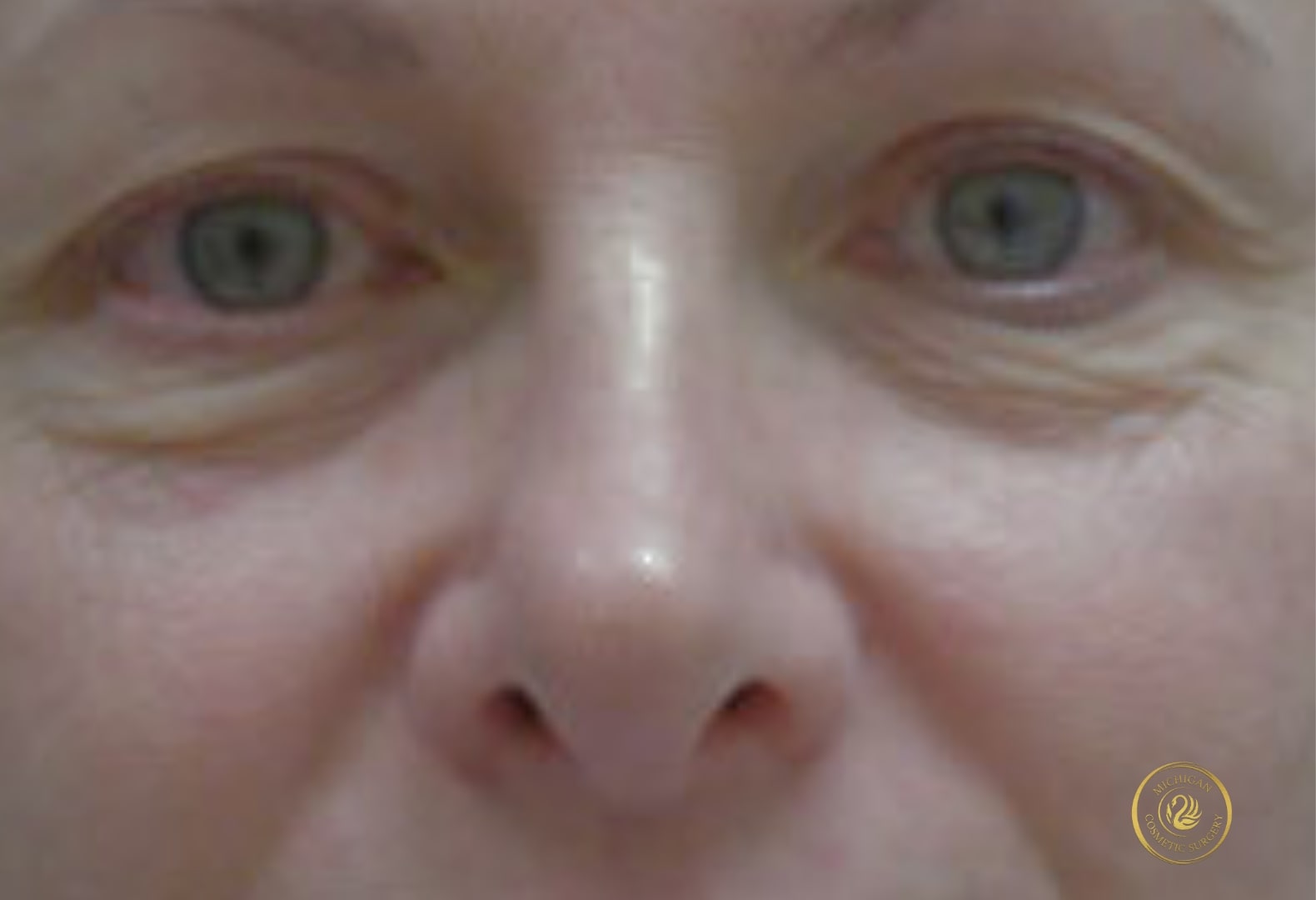 blepharoplasty before photo by michigan cosmetic surgery in southfield mi
