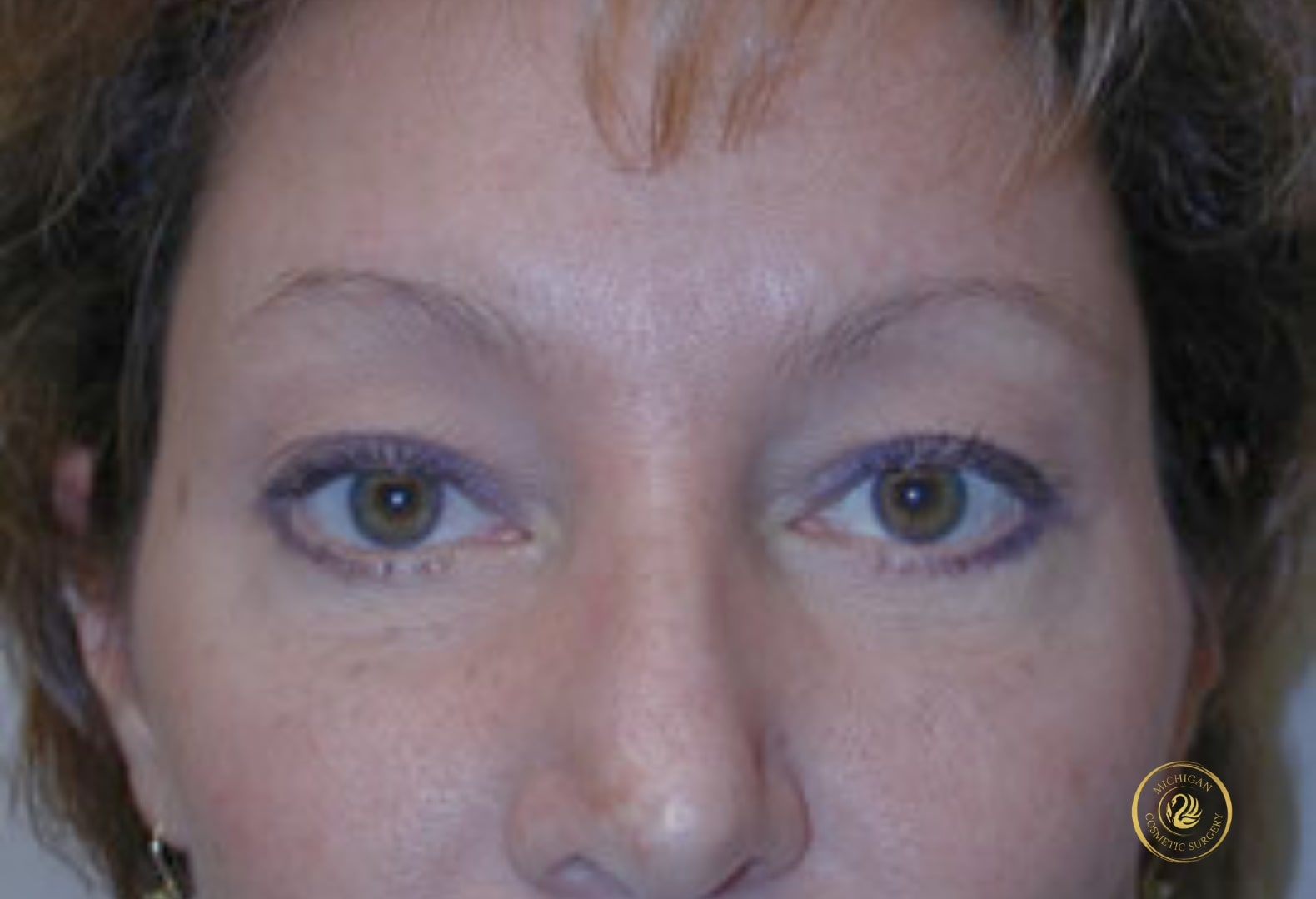 blepharoplasty after photo by michigan cosmetic surgery in southfield mi