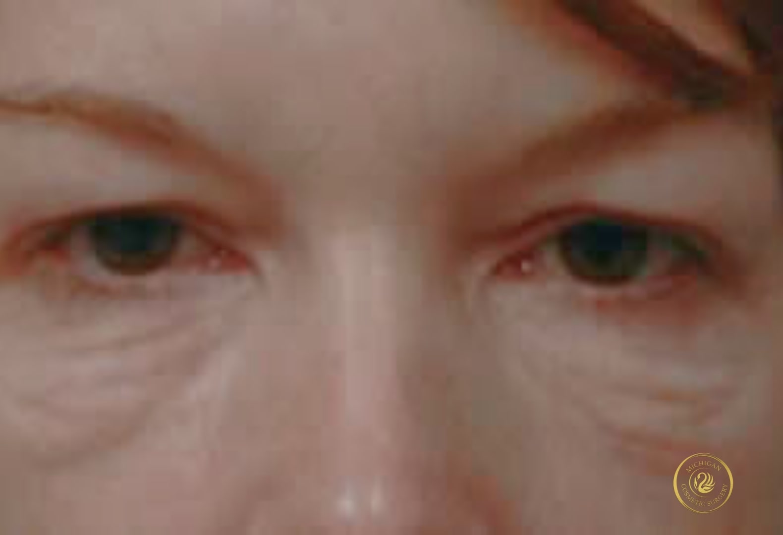 blepharoplasty before photo by michigan cosmetic surgery in southfield mi