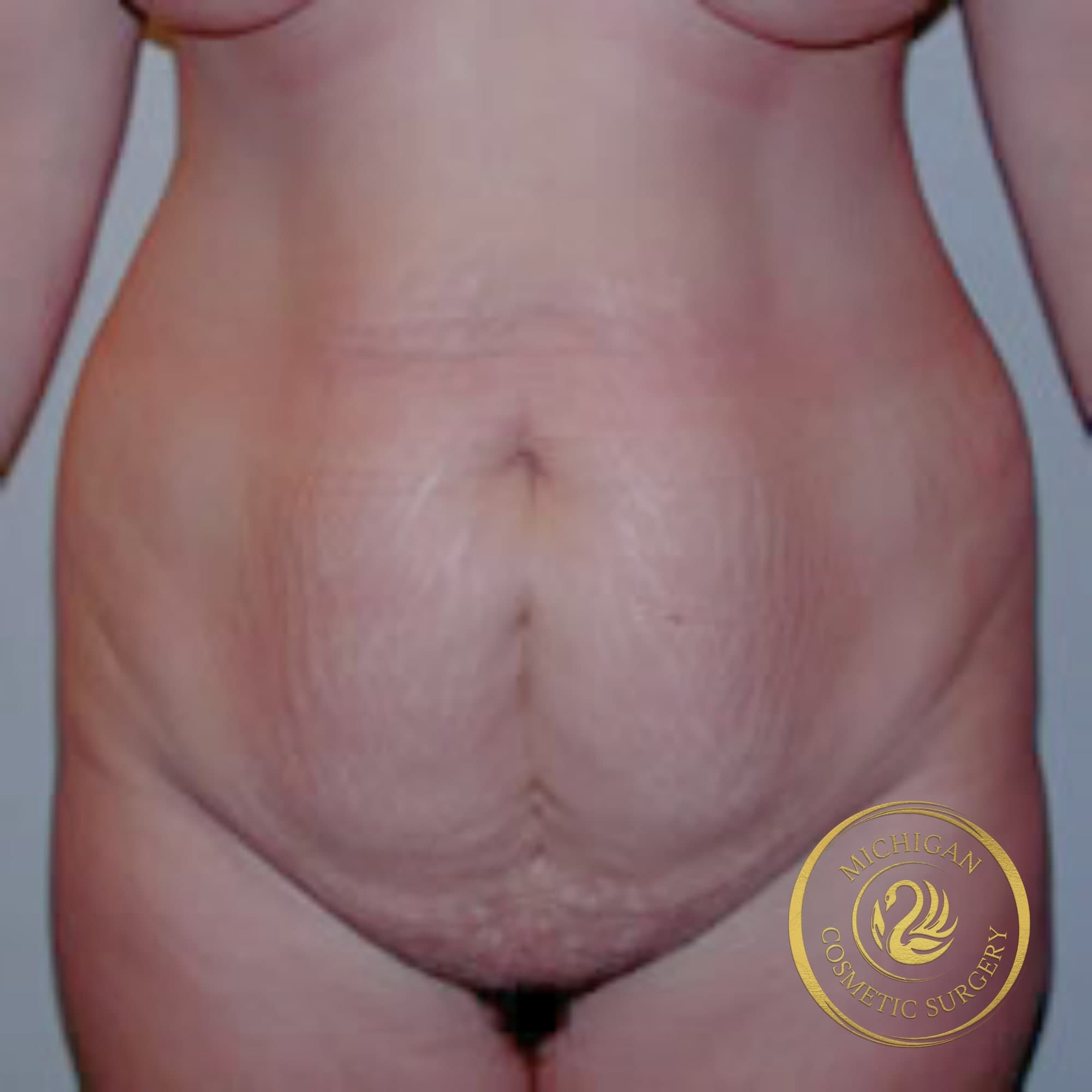 mommy makeover before photo by michigan cosmetic surgery in southfield mi