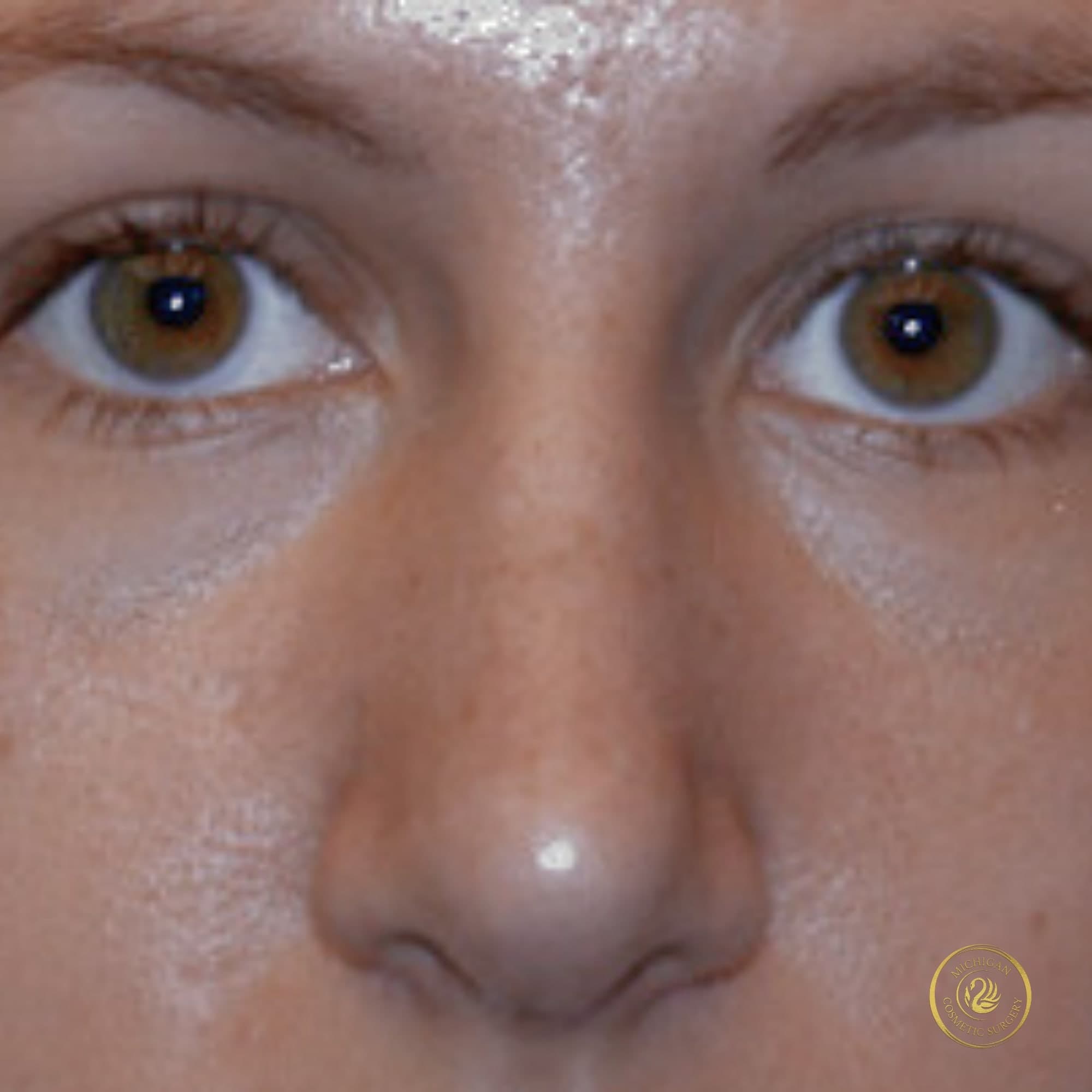rhinoplasty before photo by michigan cosmetic surgery in southfield mi