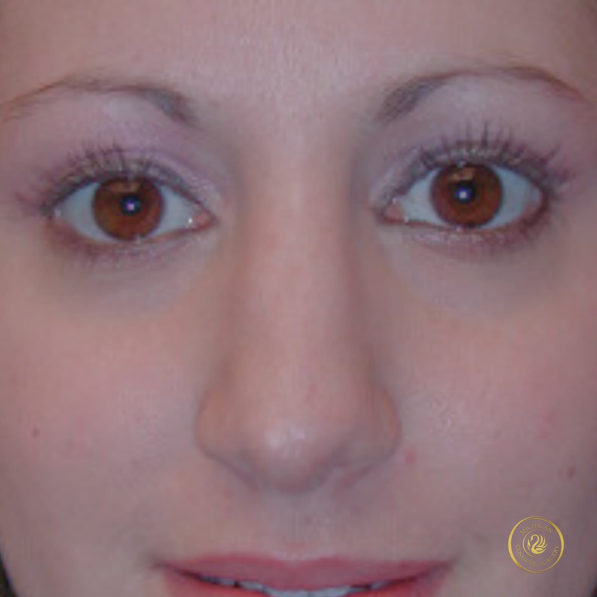 rhinoplasty before photo by michigan cosmetic surgery in southfield mi