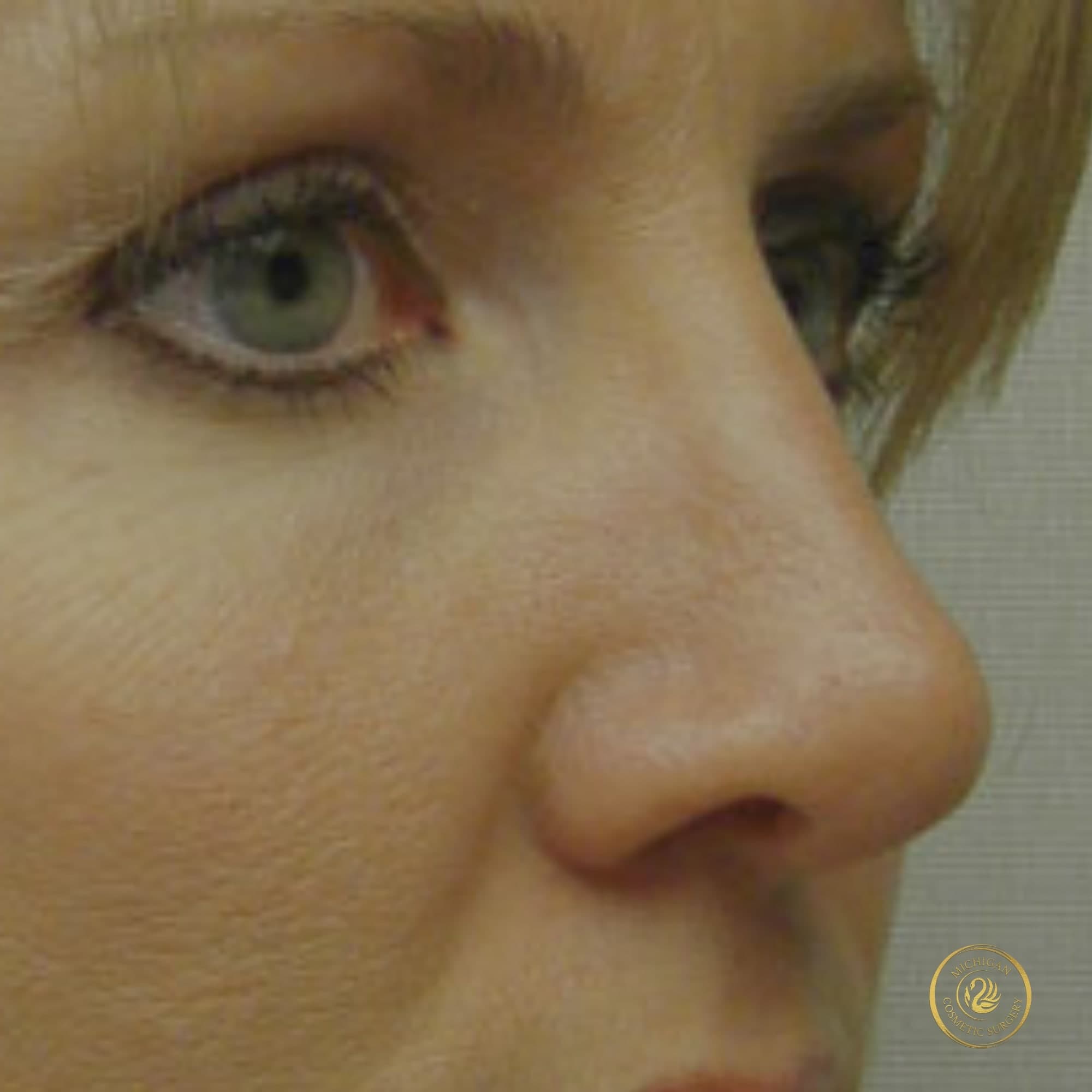 rhinoplasty after photo by michigan cosmetic surgery in southfield mi