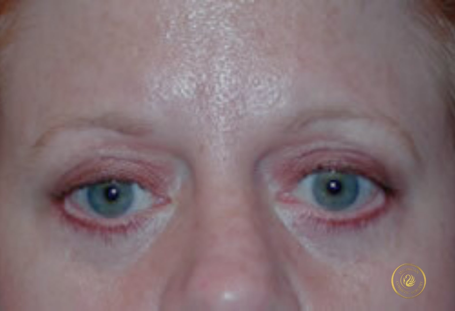blepharoplasty after photo by michigan cosmetic surgery in southfield mi