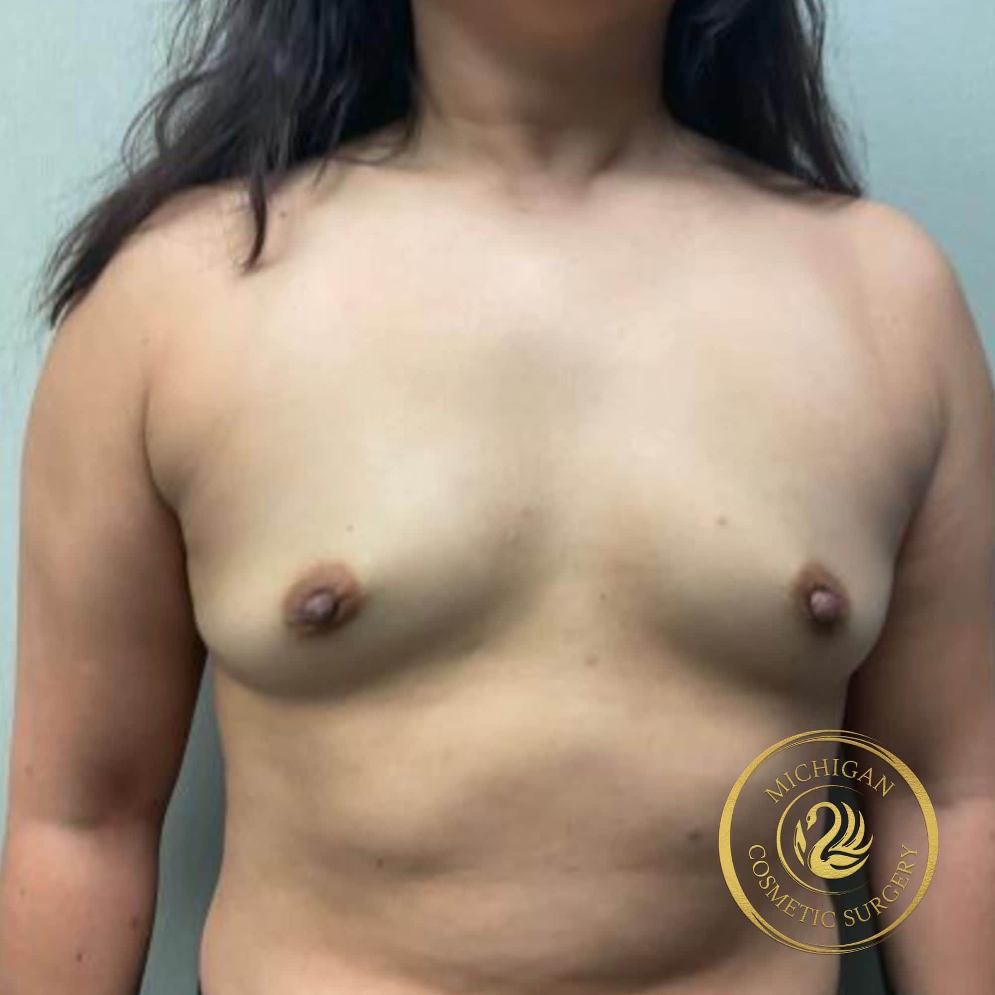 breast augmentation before photo by michigan cosmetic surgery in southfield mi