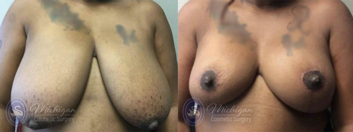 Breast Reduction Michigan