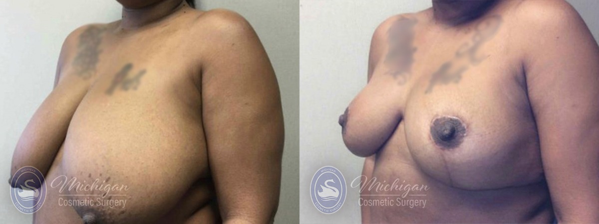 Breast Reduction Michigan