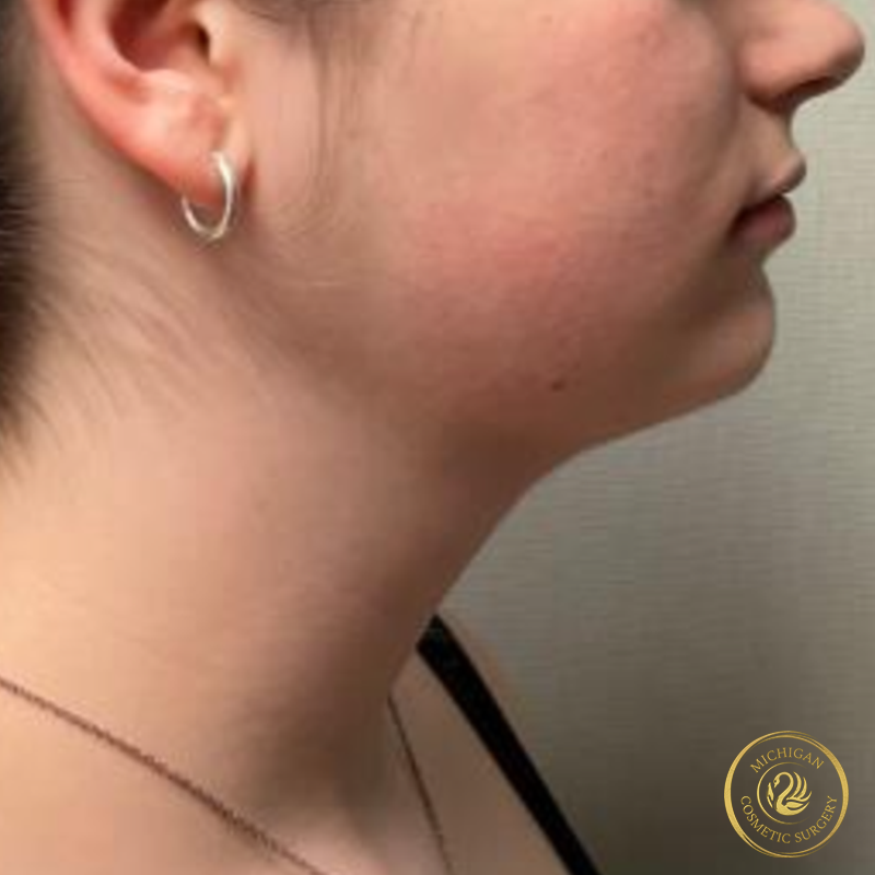 chin liposuction after photo by michigan cosmetic surgery in southfield mi