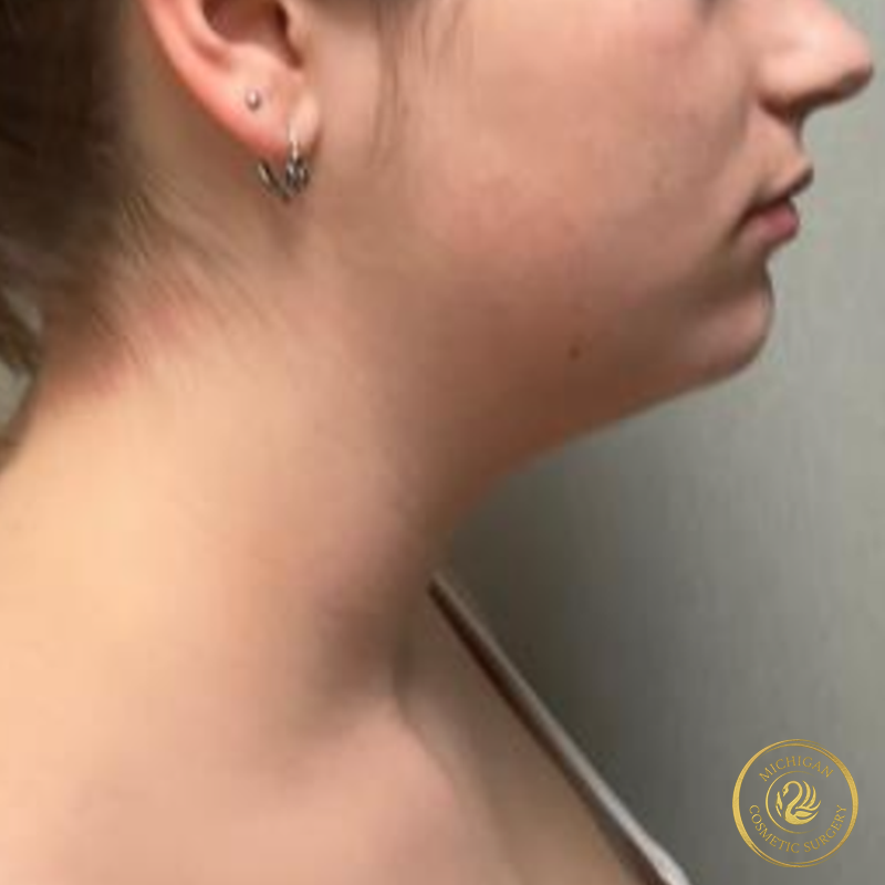 chin liposuction before photo by michigan cosmetic surgery in southfield mi
