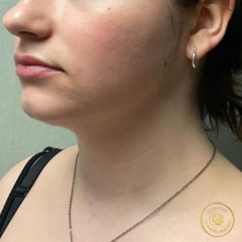 chin liposuction after photo by michigan cosmetic surgery in southfield mi