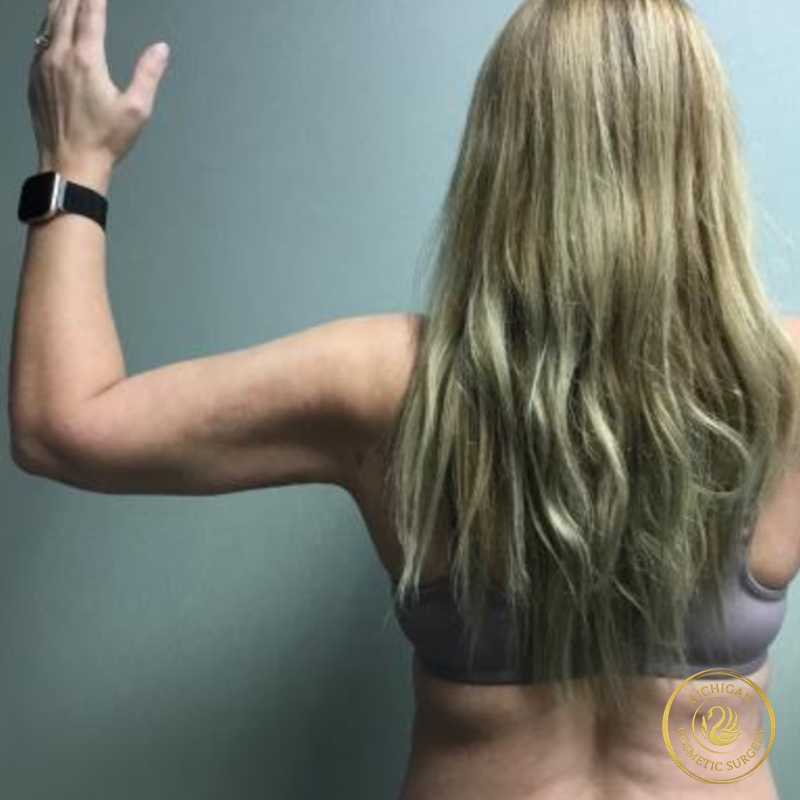 liposuction after photo by michigan cosmetic surgery in southfield mi