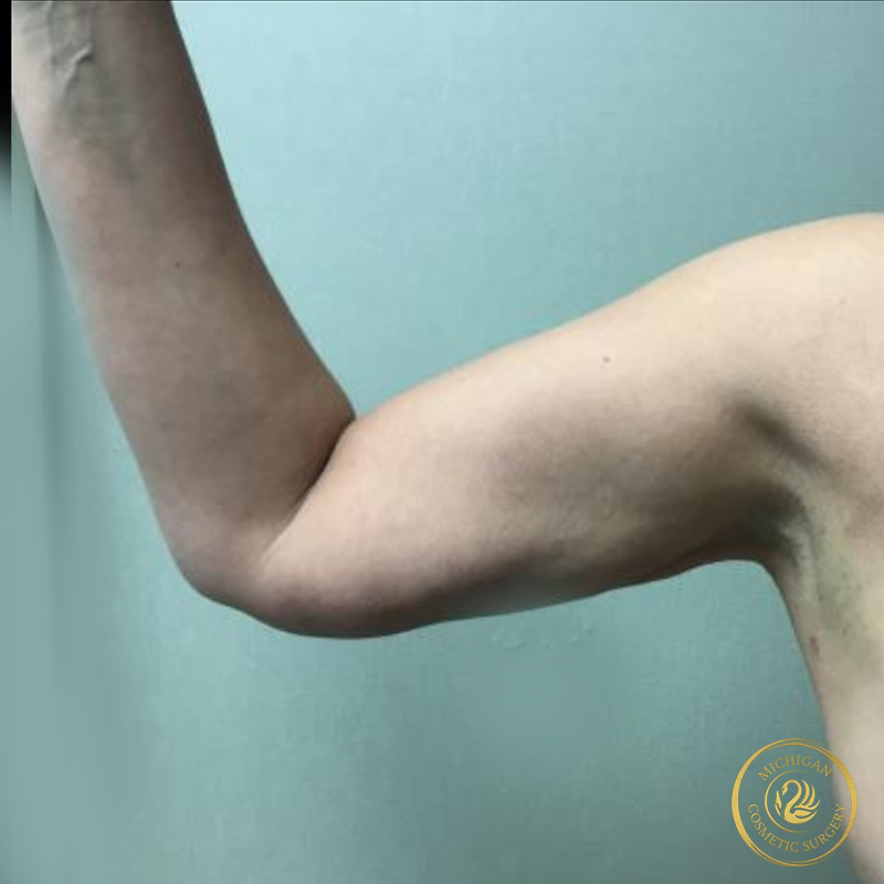 liposuction after photo by michigan cosmetic surgery in southfield mi