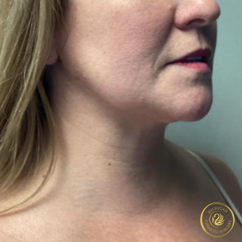 chin liposuction after photo by michigan cosmetic surgery in southfield mi