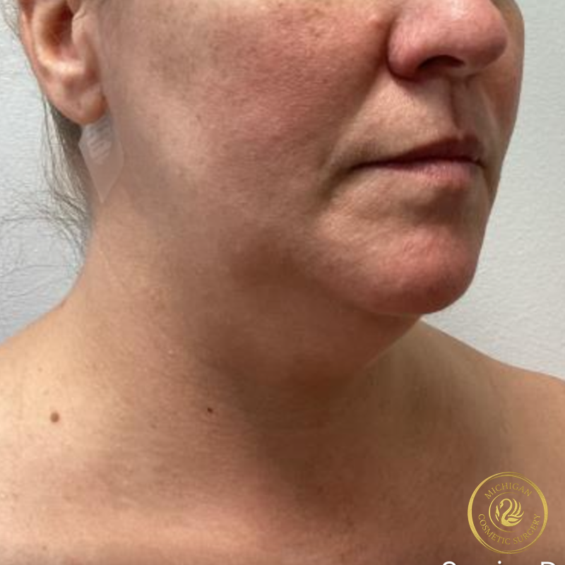 chin liposuction before photo by michigan cosmetic surgery in southfield mi