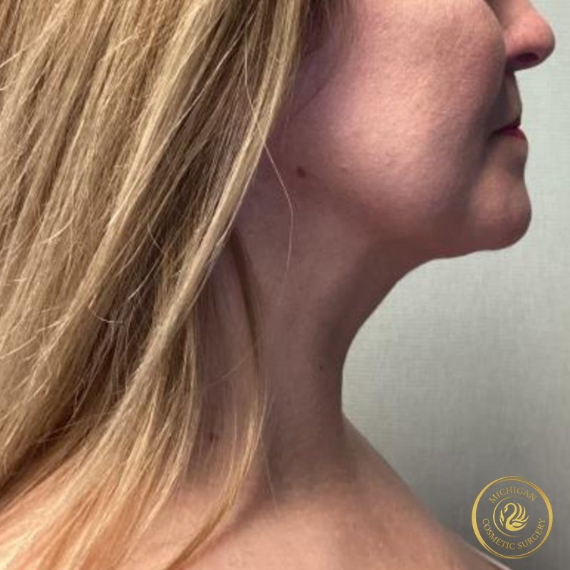 chin liposuction after photo by michigan cosmetic surgery in southfield mi