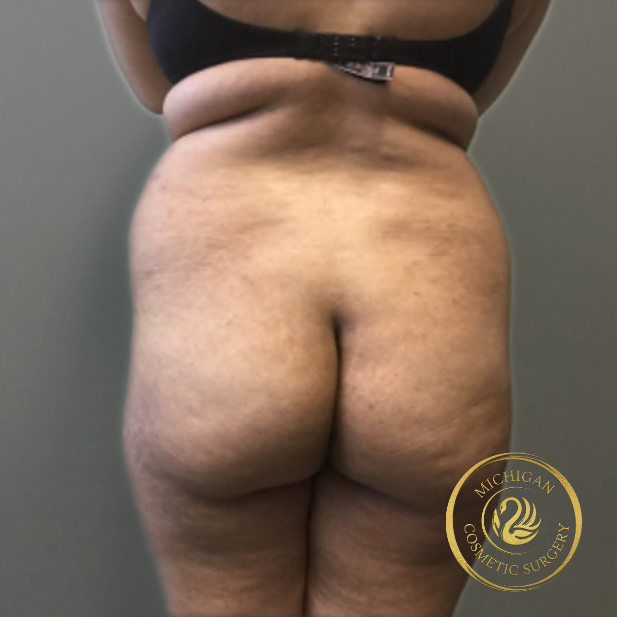 brazilian butt lift before photo by michigan cosmetic surgery in southfield mi