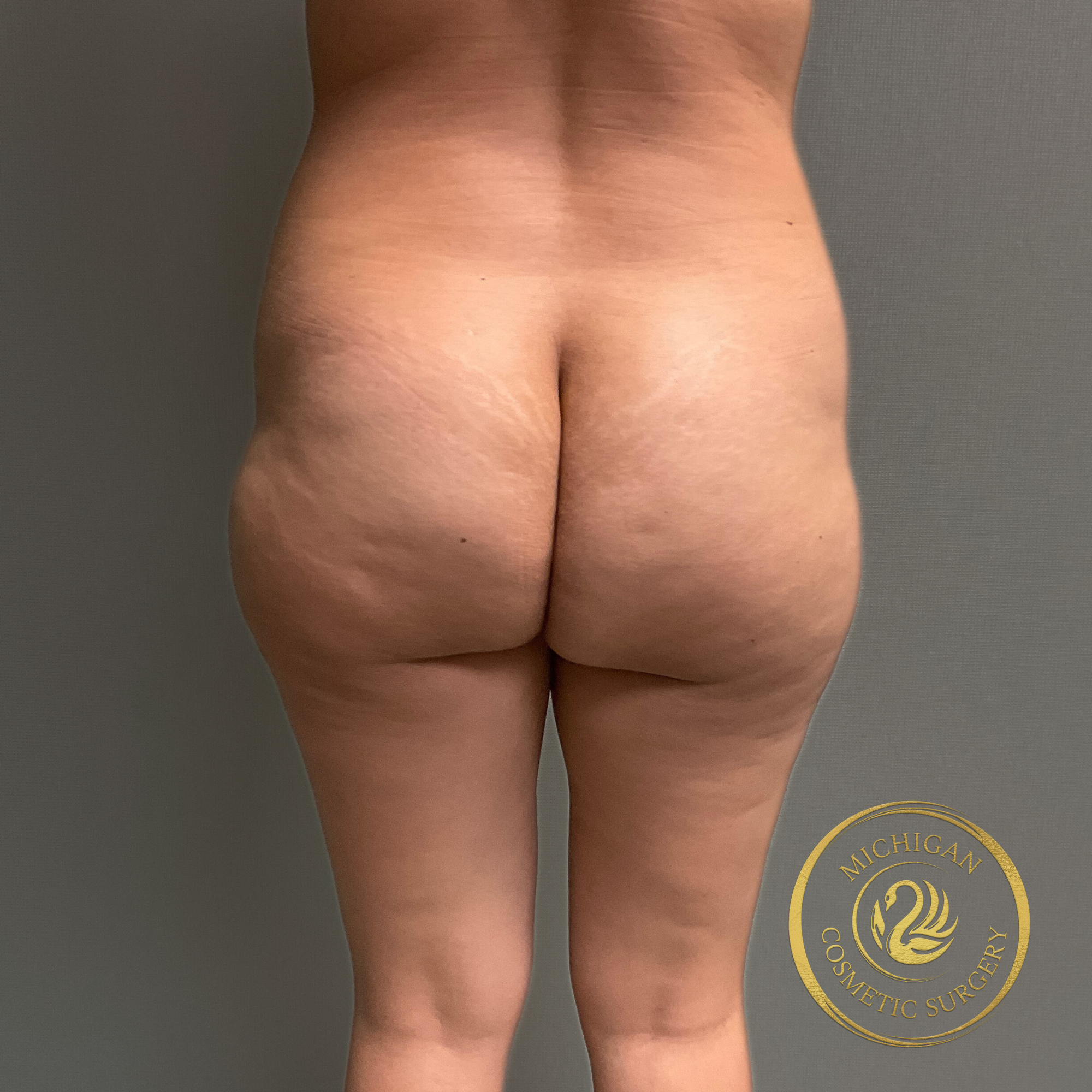 brazilian butt lift before photo by michigan cosmetic surgery in southfield mi