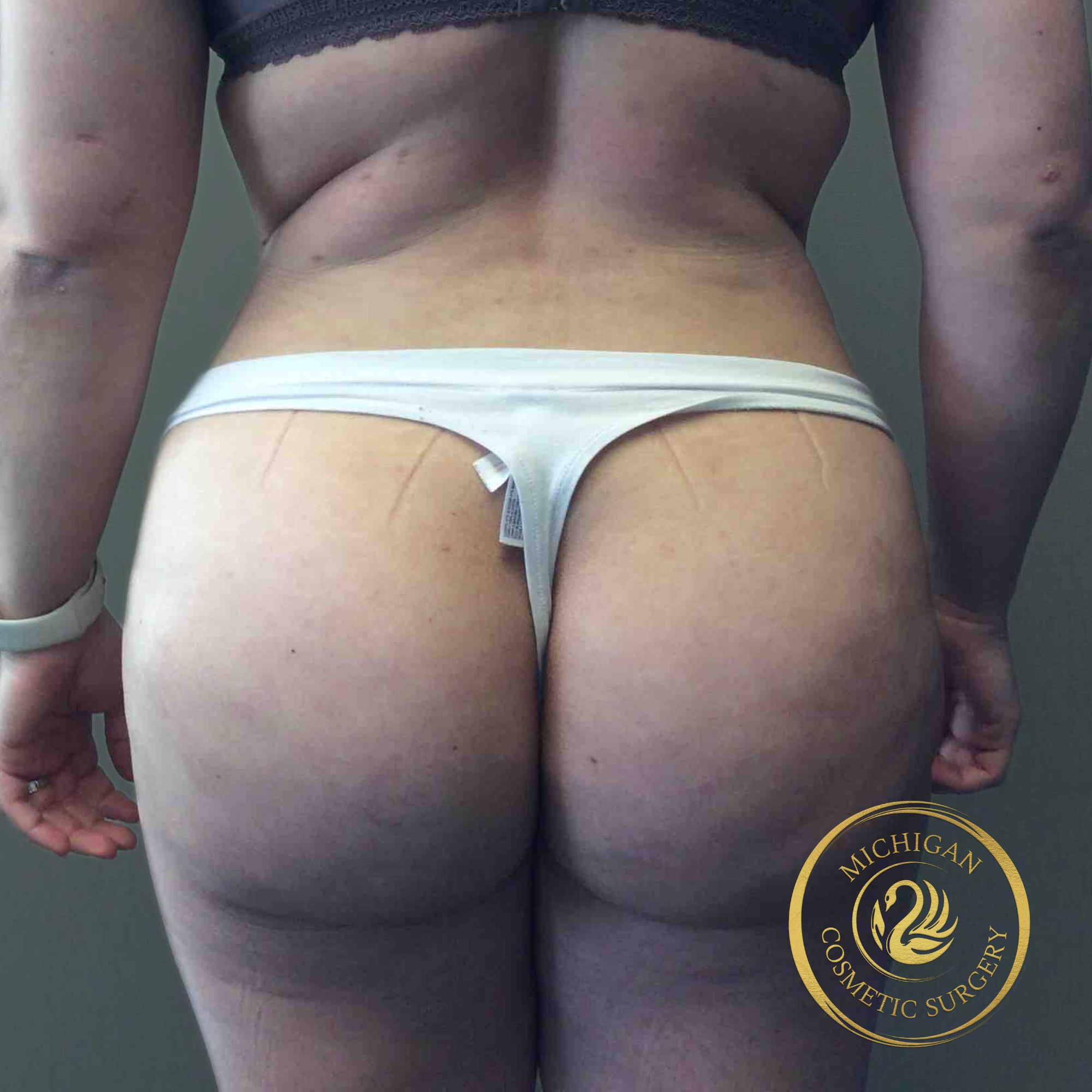 brazilian butt lift after photo by michigan cosmetic surgery in southfield mi