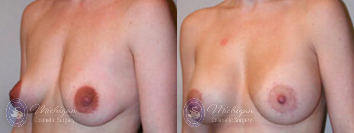 Michigan Cosmetic Surgery Southfield Breast Augmentation small lift P