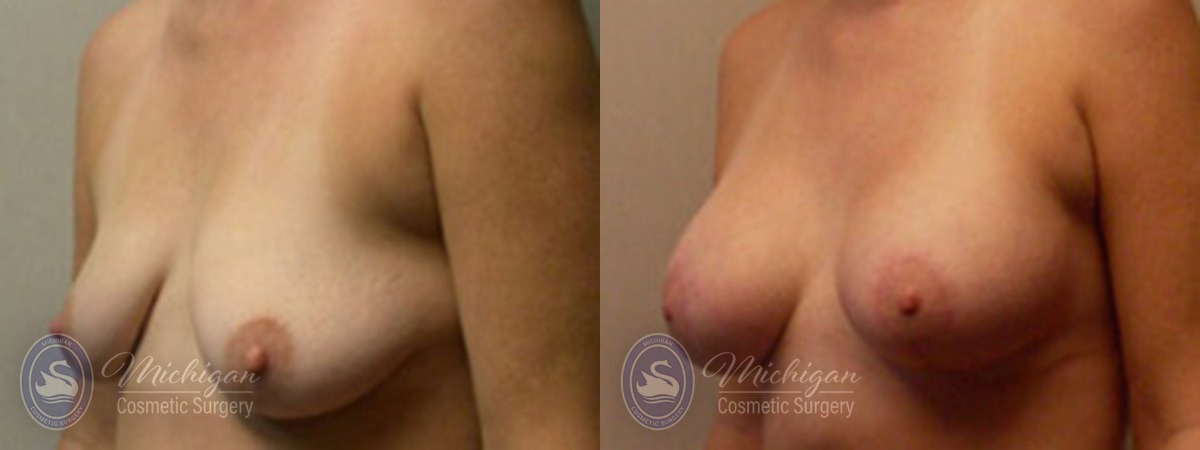 Michigan Cosmetic Surgery Southfield Breast Augmentation small lift P