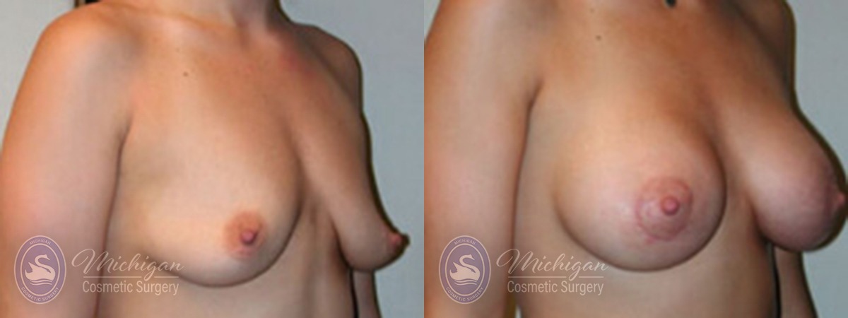 Michigan Cosmetic Surgery Southfield Breast Augmentation small lift P