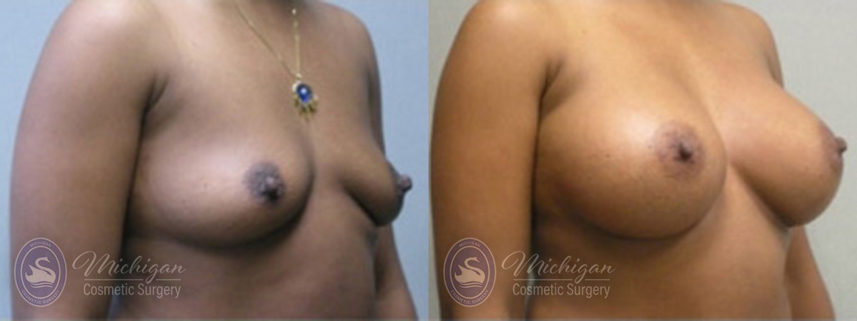Michigan Cosmetic Surgery Southfield Breast Augmentation P