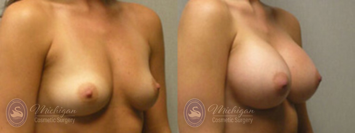 Michigan Cosmetic Surgery Southfield Breast Augmentation P
