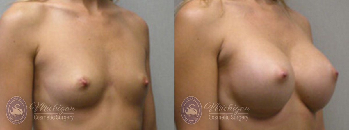 Michigan Cosmetic Surgery Southfield Breast Augmentation P