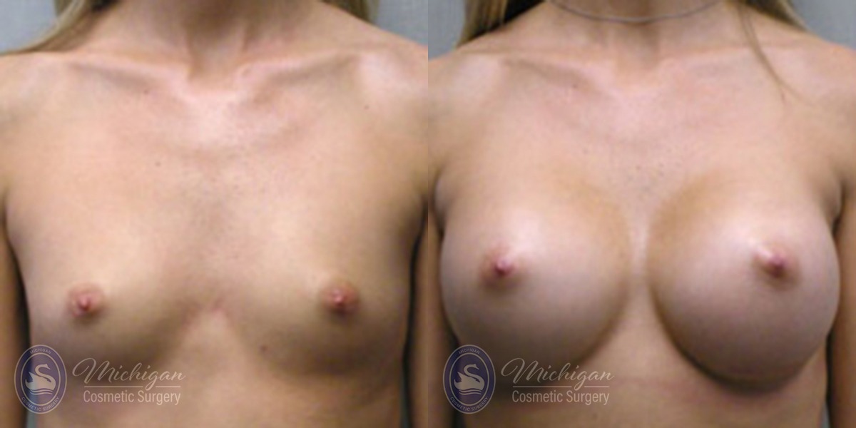 Michigan Cosmetic Surgery Southfield Breast Augmentation P
