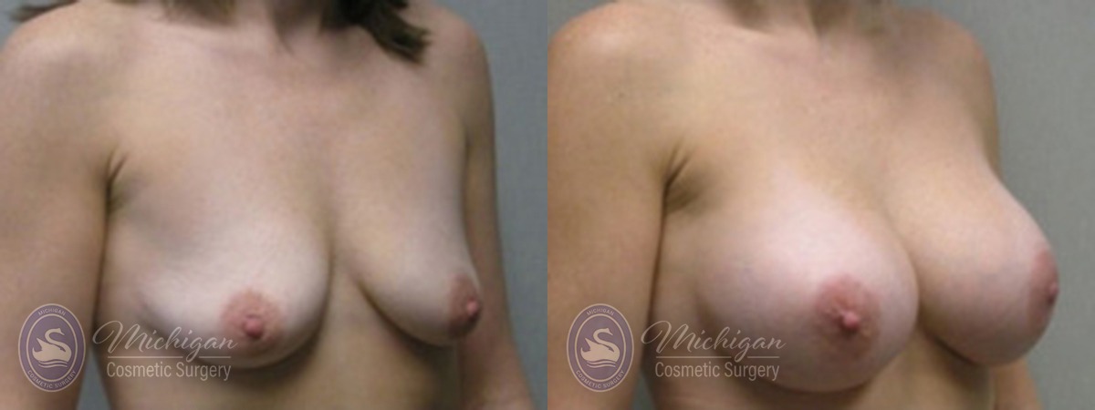 Michigan Cosmetic Surgery Southfield Breast Augmentation P