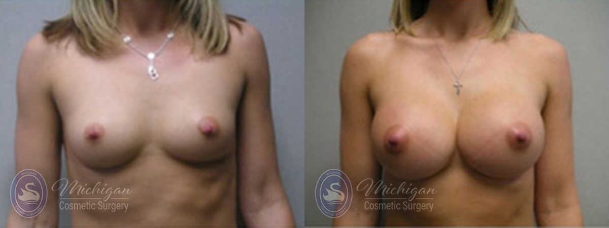 Michigan Cosmetic Surgery Southfield Breast Augmentation P
